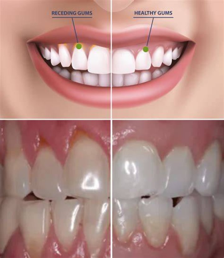 Do I need surgery on my gums?