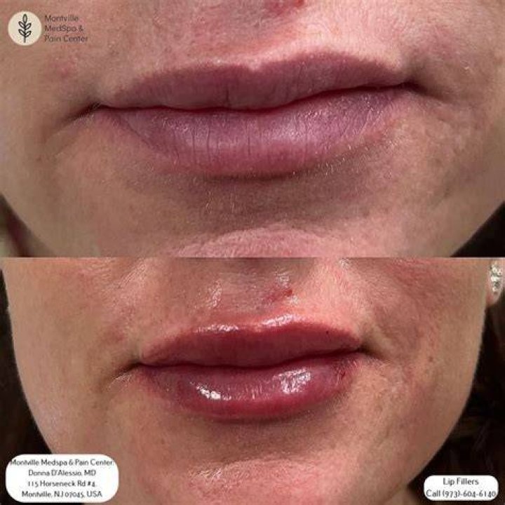 How do you eat with lip fillers?